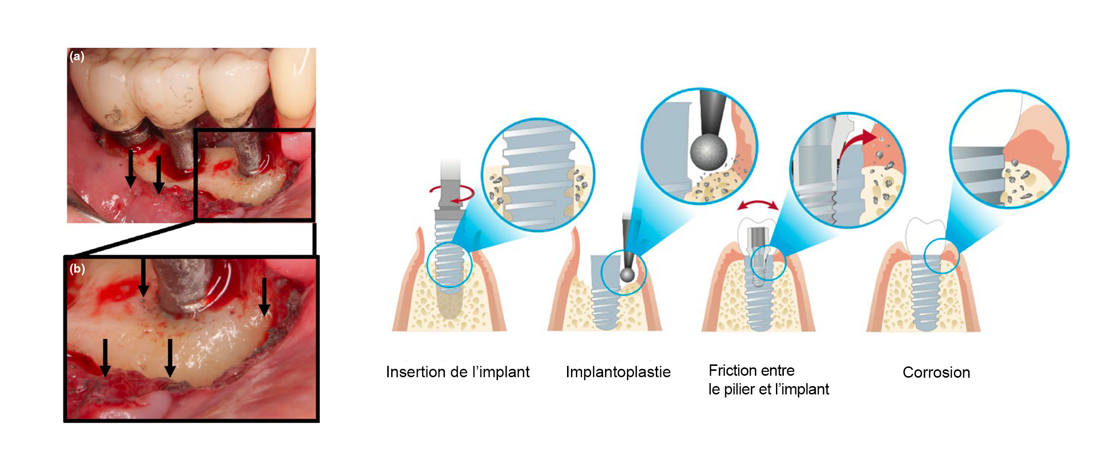 Visualisation-de-particules-peri-implantaires-1