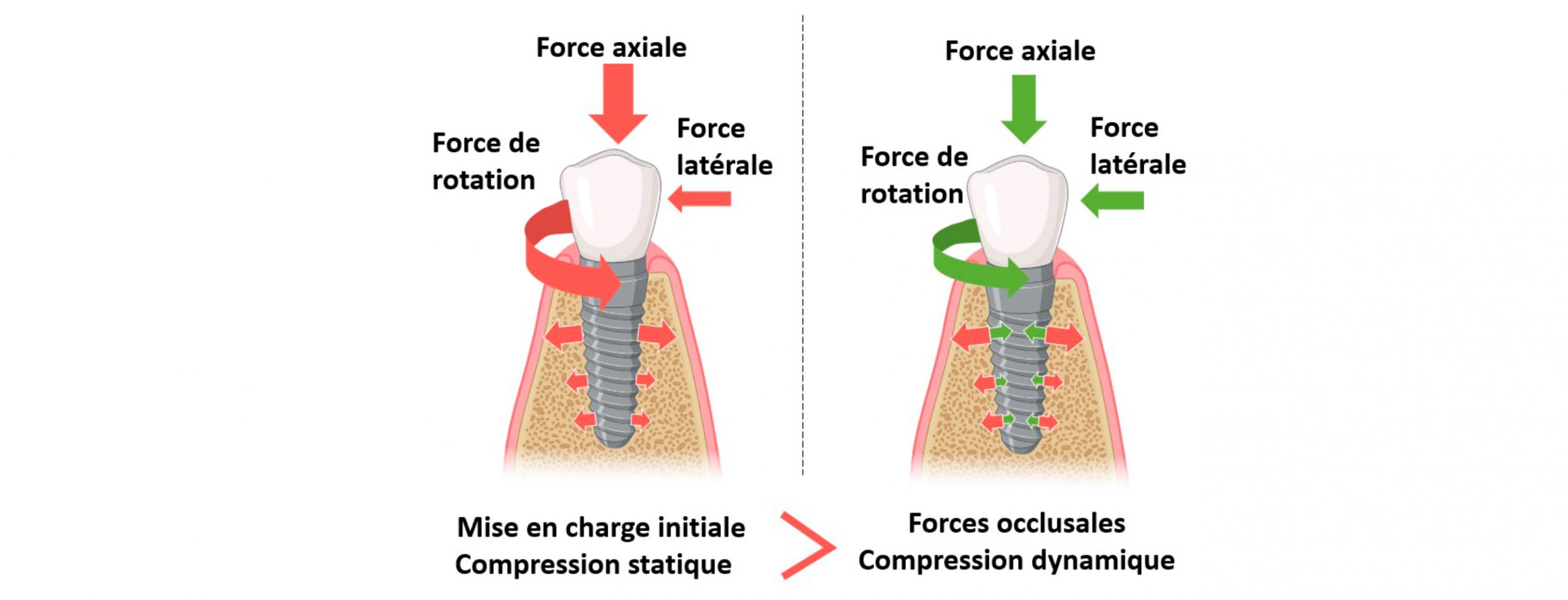 Force-axiale-stabilite-primaire