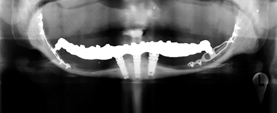 implant-dentaire-diskimplants-radio