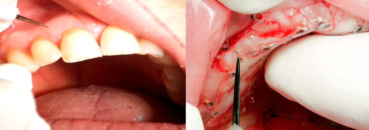 implant-dentaire-photos-bouche