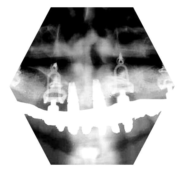 osteogenique-2