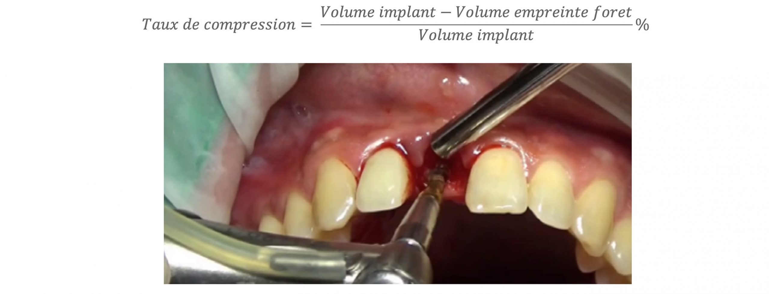 volume-implant-2