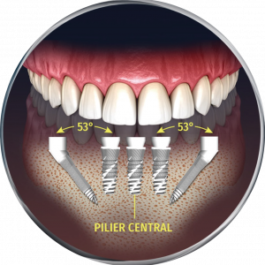 all-on-five all-on-five